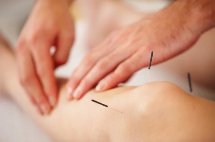 acupuntura